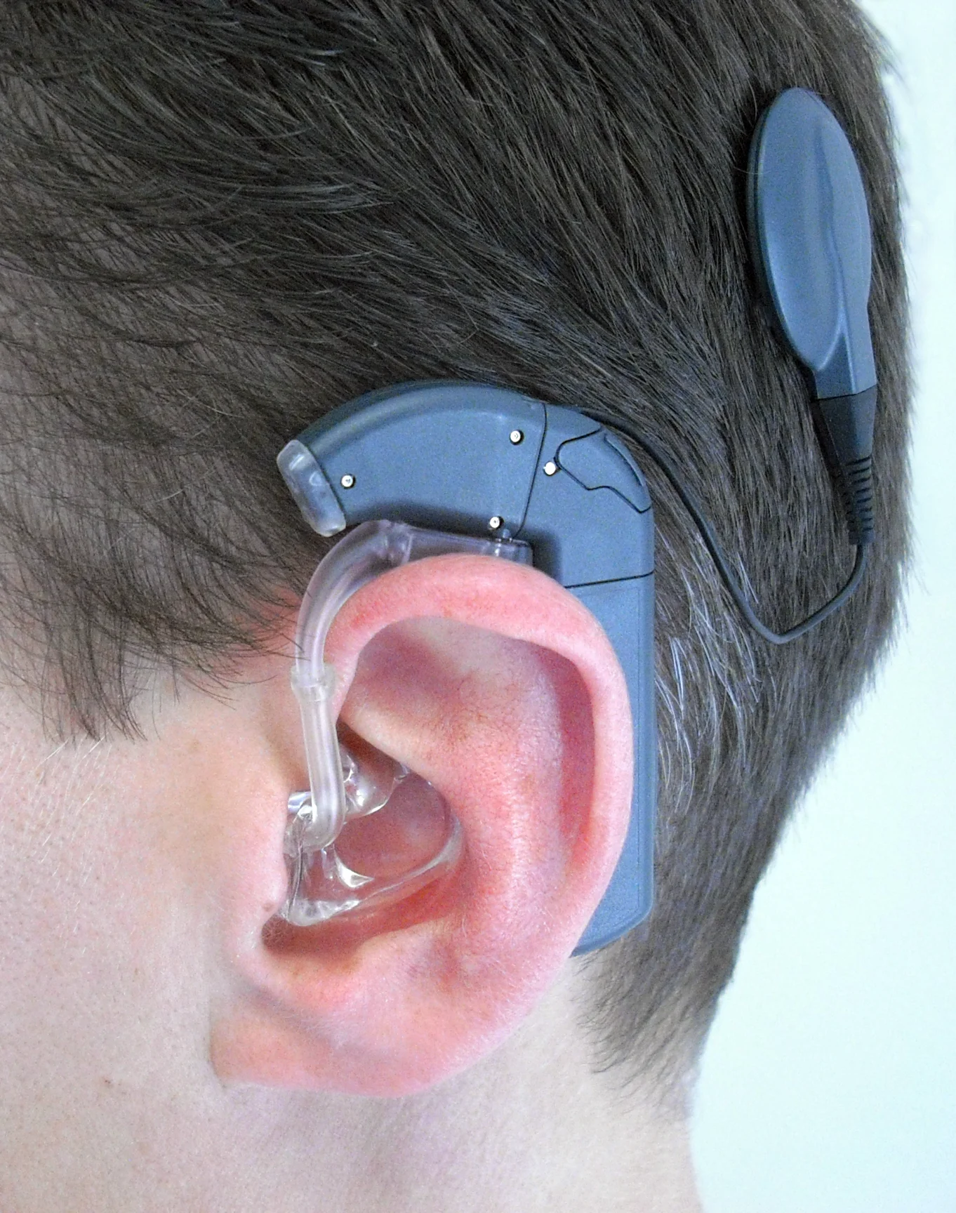 cochlear-implant_638440245052030160.webp